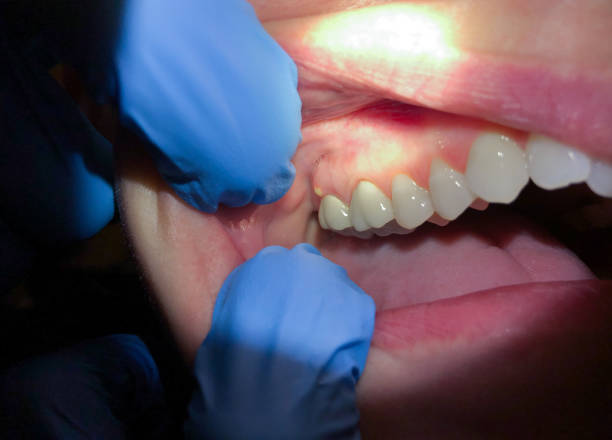 Best Knocked-Out Tooth (Avulsed Tooth) Treatment in Prairie Creek, AR